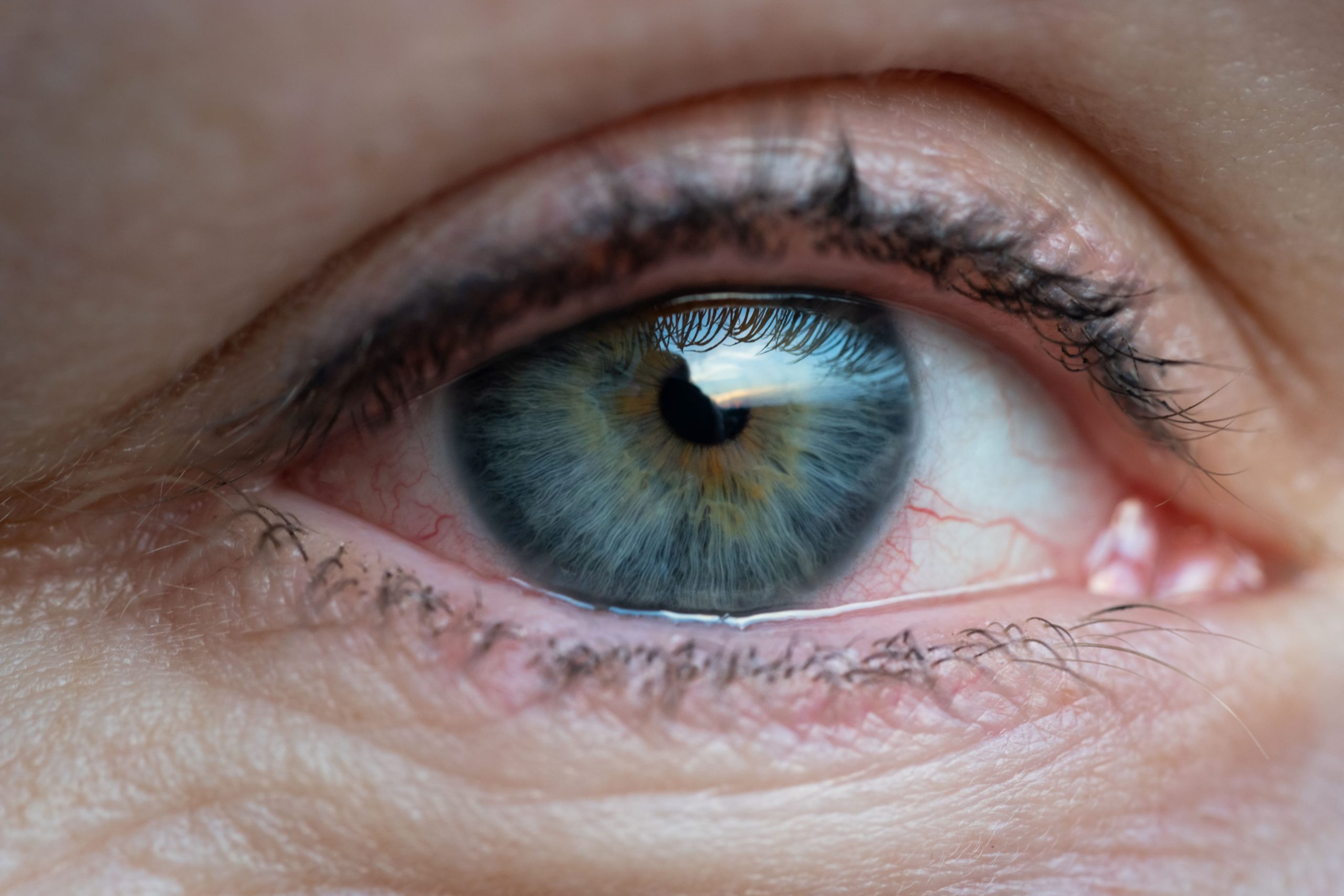 girl-with-irritated-dry-red-eye-or-allergy-female-2022-11-15-04-07-04-utc-min