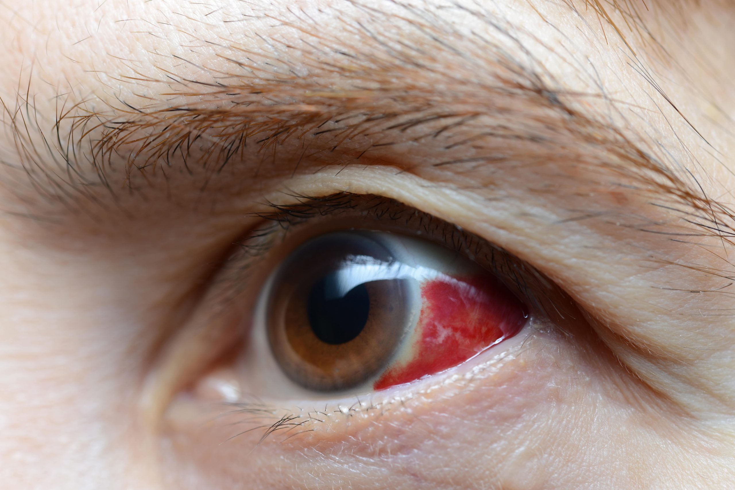 woman-with-red-eye-2021-08-26-20-10-10-utc-min